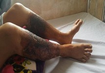 Bị bỏng nặng hai chân khi lội qua mương có chất thải độc hại