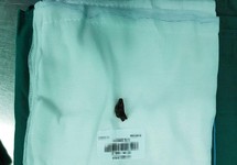 Mảnh đạn 40 năm nằm trong ổ bụng tạo ổ áp xe khổng lồ