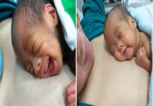 Sức sống mãnh liệt của bé gái sinh ra chỉ nặng 700gr