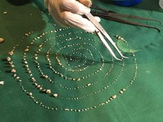 Kỳ lạ bé 7 tuổi có 526 chiếc răng