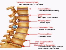 Quá trình bạn bị thoát vị đĩa đệm diễn ra như thế nào