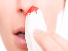 Mẹo nhỏ giúp máu cam ngừng chảy hiệu quả