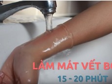 Mẹo hay - Dễ làm: 3 bước sơ cứu khi bị bỏng