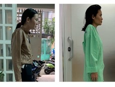 Căn bệnh khiến cô gái 30 tuổi bị còng như 60 tuổi