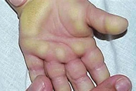 Tái xuất hội chứng viêm da dày sừng tay chân