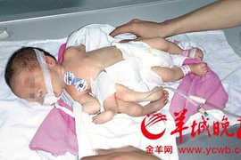 Em bé 8 chân tay ở Trung Quốc