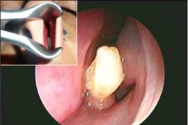 Kỳ lạ răng… mọc trong mũi