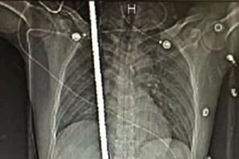 Sống sót kì diệu dù bị thanh sắt 2m đâm xuyên người