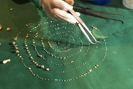 Kỳ lạ bé 7 tuổi có 526 chiếc răng