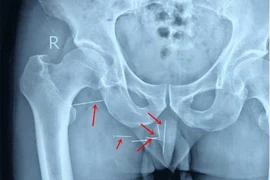 Bị 8 cây kim găm vào mông 10 năm mà không hề hay biết