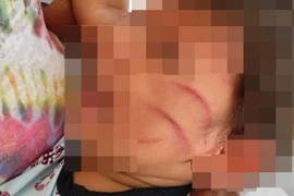 Bé 2 tuổi bị đánh tàn nhẫn vì làm hư vỏ bọc điện thoại