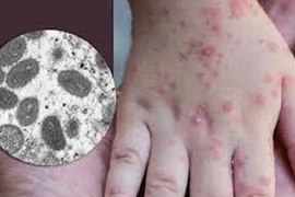 Ca nghi mắc đậu mùa khỉ tại Đà Nẵng có xét nghiệm âm tính