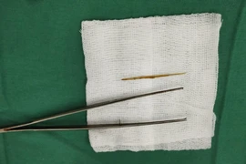 Thủng ruột non do nuốt tăm tre