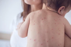 Số ca mắc bệnh sởi tăng đột biến trên toàn thế giới, Bộ Y tế khuyến cáo gì?