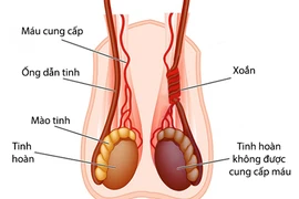 Bé trai 28 ngày tuổi bị xoắn tinh hoàn, phải cắt bỏ toàn bộ