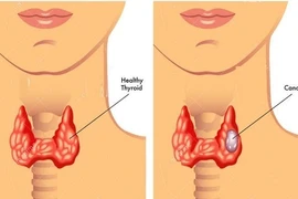 Bị ung thư di căn ở tuổi 24