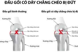 Sau 20 năm bị ngã mới biết mình bị đứt dây chằng khớp gối