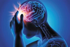Đột quỵ não sau khi uống rượu