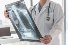 Bị ung thư phổi sống được bao lâu?