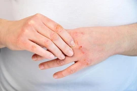 6 triệu chứng ngứa da cảnh báo bệnh tiểu đường