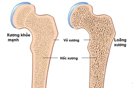 5 nhóm dấu hiệu cảnh báo loãng xương