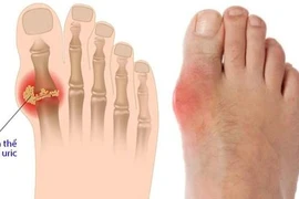 Không chỉ thịt đỏ, đây là những thực phẩm cực hại cho người bệnh gút
