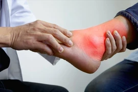4 sai lầm thường gặp khi điều trị bệnh gút