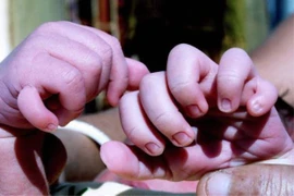 Kỳ lạ bé sơ sinh có 31 ngón tay và ngón chân