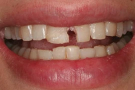 Răng tự nhiên bị mẻ là bị bệnh gì?