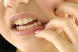 Tất cả những điều bạn cần biết về răng khôn