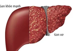 Hiểu đúng và đủ về bệnh xơ gan