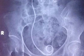 Bỏ quên 'vật lạ' trong cơ thể hàng chục bệnh nhân suốt 10 năm