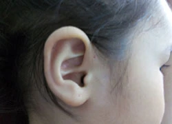 Lỗ nhỏ xíu như đầu kim ở vành tai trẻ là bệnh gì ?