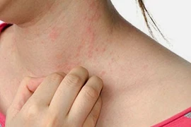 Bệnh mề đay trị sao cho dứt?