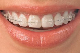 Niềng răng nguy hiểm thế nào?