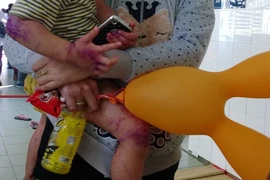 Phòng ngừa bệnh thủy đậu