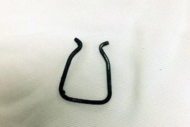 Mổ nội soi lấy kẹp giấy trong lồng ngực bé 26 tháng tuổi