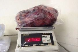 Cắt bỏ quả thận nặng gần 3 kg
