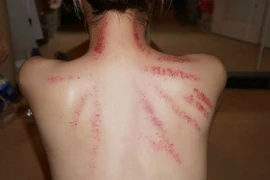 Những sai lầm nguy hiểm khi cạo gió