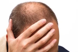 Hói đầu và ung thư tuyến tiền liệt: Có liên quan!