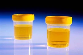 Xét nghiệm nước tiểu có thể phát hiện ung thư