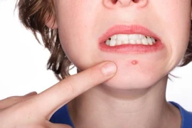 Cách điều trị mụn trứng cá