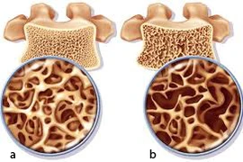 Phân biệt bệnh nhuyễn xương và loãng xương