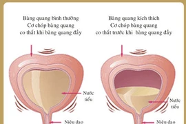 Đi tiểu nhiều, có phải bệnh lý?