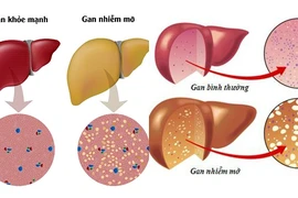 Gan nhiễm mỡ - Bệnh thời hiện đại