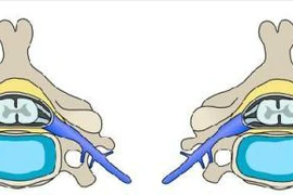 Dấu hiệu thoát vị đĩa đệm cột sống cổ