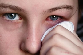Phân biệt các loại viêm kết mạc mắt