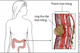 6 cách giảm nguy cơ bị ung thư trực tràng