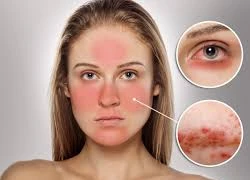 Thường xuyên đỏ mặt là triệu chứng bệnh mất trí nhớ?