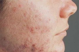 Cách xử lý khi bị viêm da cơ địa